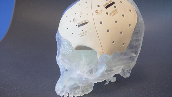 Cấy ghép hộp sọ tùy chỉnh được in 3D